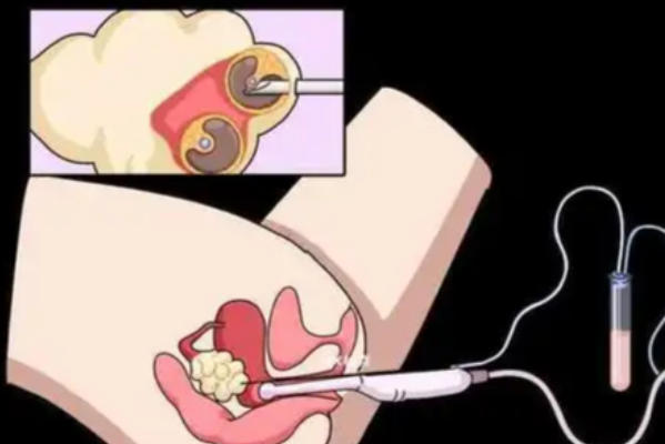 取卵手术疼痛受麻醉方式的影响