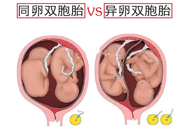 试管单卵双胎的概率?