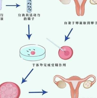 试管ivf和icsi什么意思?区别在受精方式和适用人群