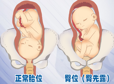 孕晚期臀位注意事项