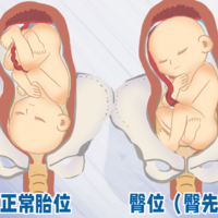 孕晚期臀位注意事项 出现臀位胎位的措施