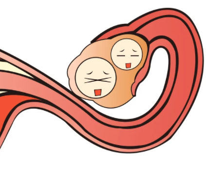 排卵障碍可以做试管婴儿吗，排卵障碍必须做试管才能怀孕吗?