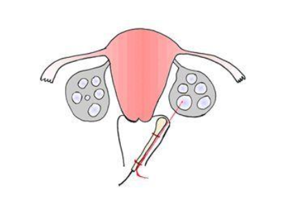 试管取卵穿刺膀胱多久恢复？膀胱穿刺会出血严重吗？