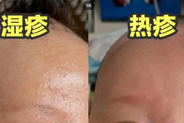 新生儿湿疹和热疹的形成原因不同