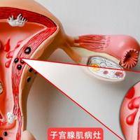 子宫腺肌症移植前如何提高成功率?改善环境 + 科学干预是核心