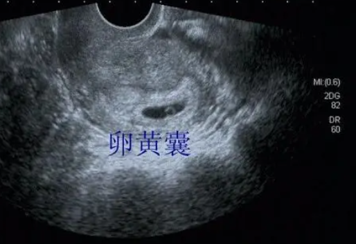 六周见卵黄囊无胎心胎芽是胚胎质量不好吗？多久才能见胎心