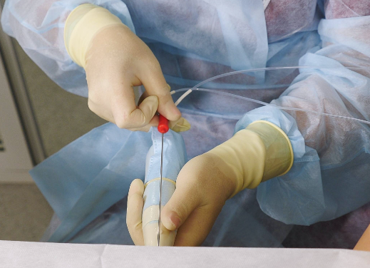 胚胎移植手术