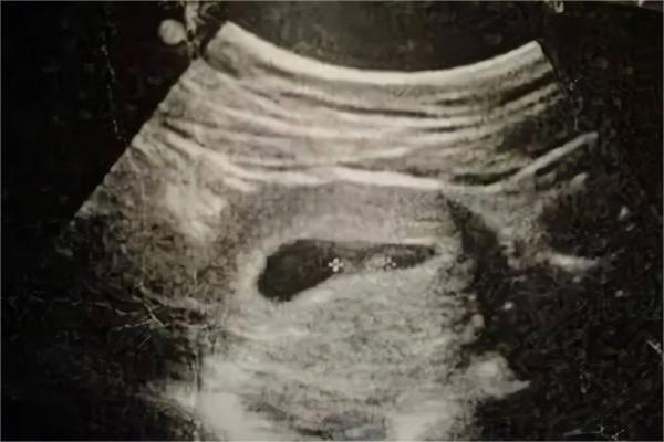 孕囊尺寸能评估胎儿发育情况