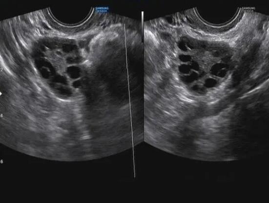 B超检测卵泡数量有差异