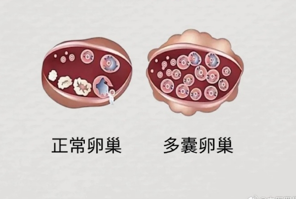 多囊患者并不会不容易老