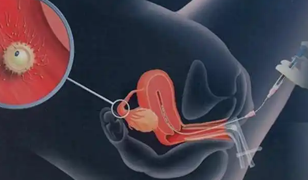 卵巢过度刺激综合征的类型