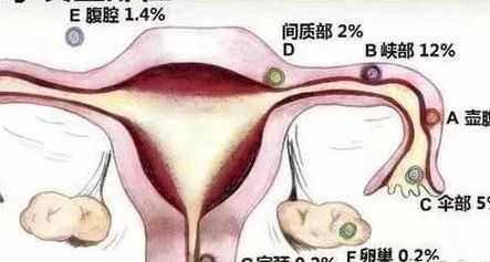 试管婴儿会出现宫外孕，4个判断维度帮你提前避坑