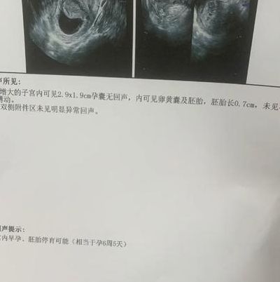 试管婴儿胎停育，胚胎染色体和母体因素先查哪个？