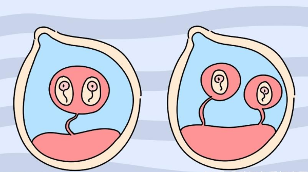 双胞胎的孕囊数量