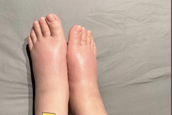 孕期水肿并不能代表孕妇身体好