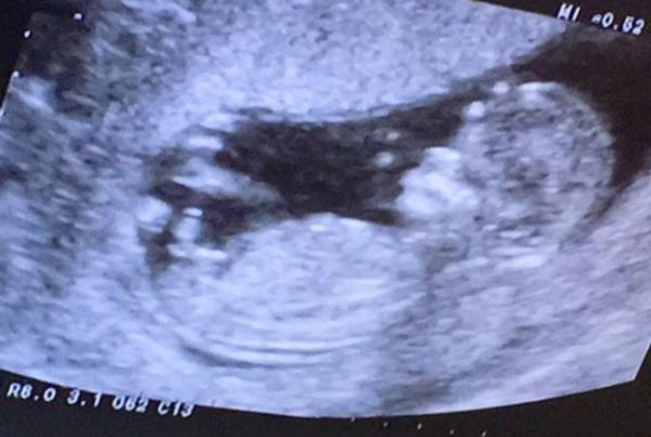 脐带位置会影响B超画面