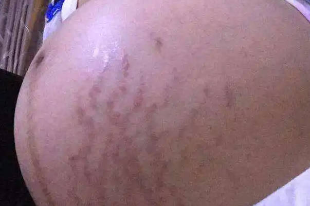 女性怀孕后肚子上若没黑线基本上是生女宝宝了真的假的？