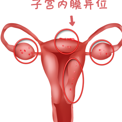 无输卵管可以做试管吗？关键看这三点和子宫条件