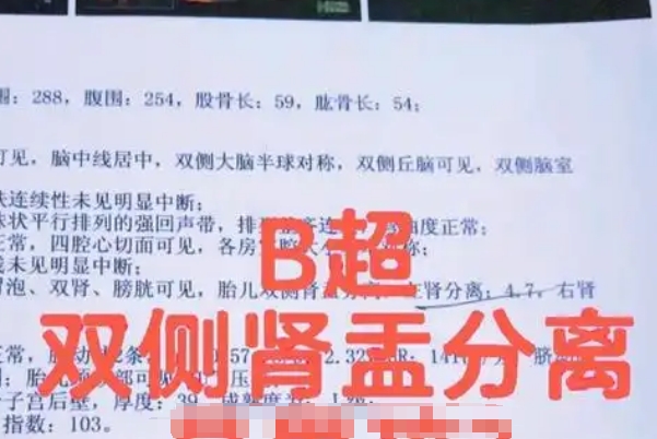女胎也有可能肾盂分离