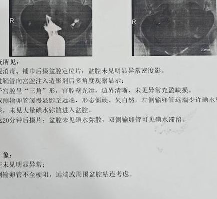 输卵管堵塞跟男人有关系么?34岁小周的经历值得备孕夫妻看看