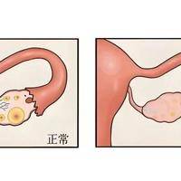 卵巢早衰可以做试管吗？关键看还有没有可用的卵泡