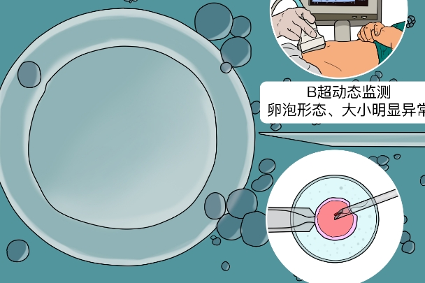 第三代试管取卵数量受年龄的影响