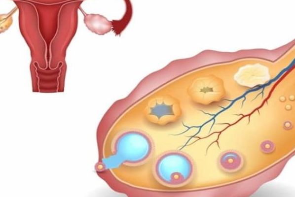 什么症状可以做试管婴儿？输卵管堵塞、排卵障碍都算