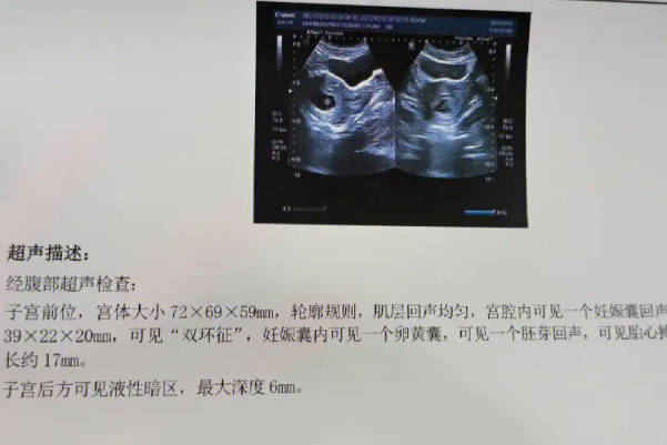胎心在140次以下是怀男孩