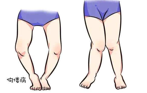 o型腿矫正的5个方法 o型腿矫正的5个方法