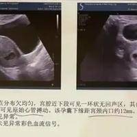 45天怀女孩孕囊图片 45天孕囊看男女准确性