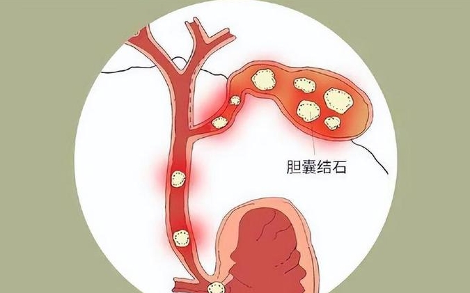 8mm胆囊结石不建议做试管