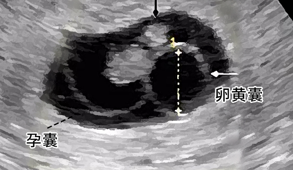 囊胚试管26天孕囊标准大小和鲜胚、冻胚有什么区别?