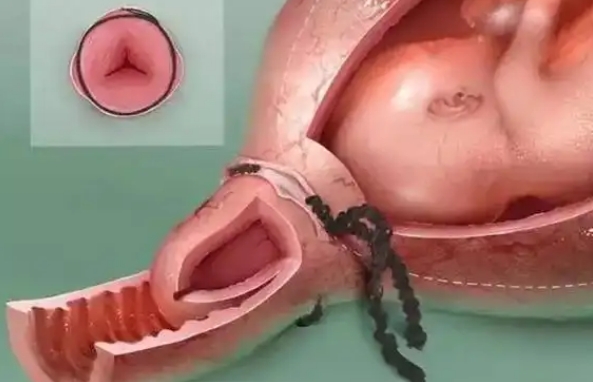孕期宫颈管长度
