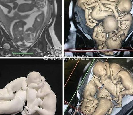 试管婴儿以后有生育能力吗 我32岁试管后说点大实话