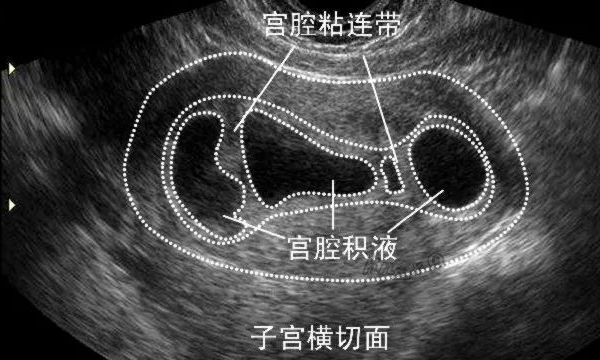 宫腔积液会影响怀孕