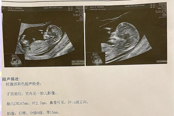 nt值无法判断胎儿是男是女