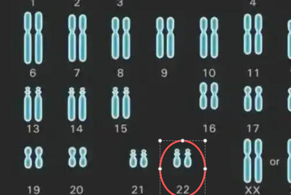 22号染色体三体跟父母谁有关?别再纠结怪谁科学看待最重要