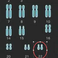 22号染色体三体跟父母谁有关?别再纠结怪谁科学看待最重要
