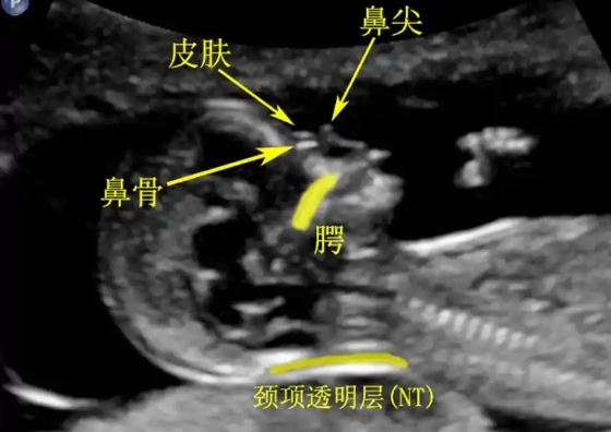 胎儿鼻骨正常值对照表