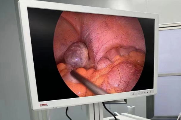 宫腔镜检查可以查看子宫环境