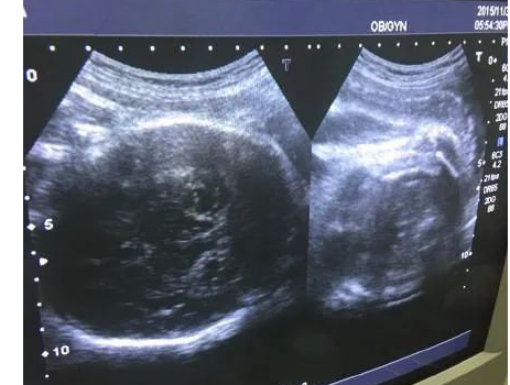 有卵黄囊了不一定代表稳了
