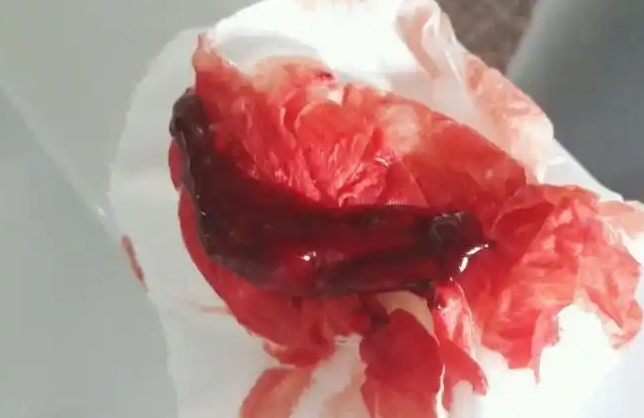 早孕出血还是经血
