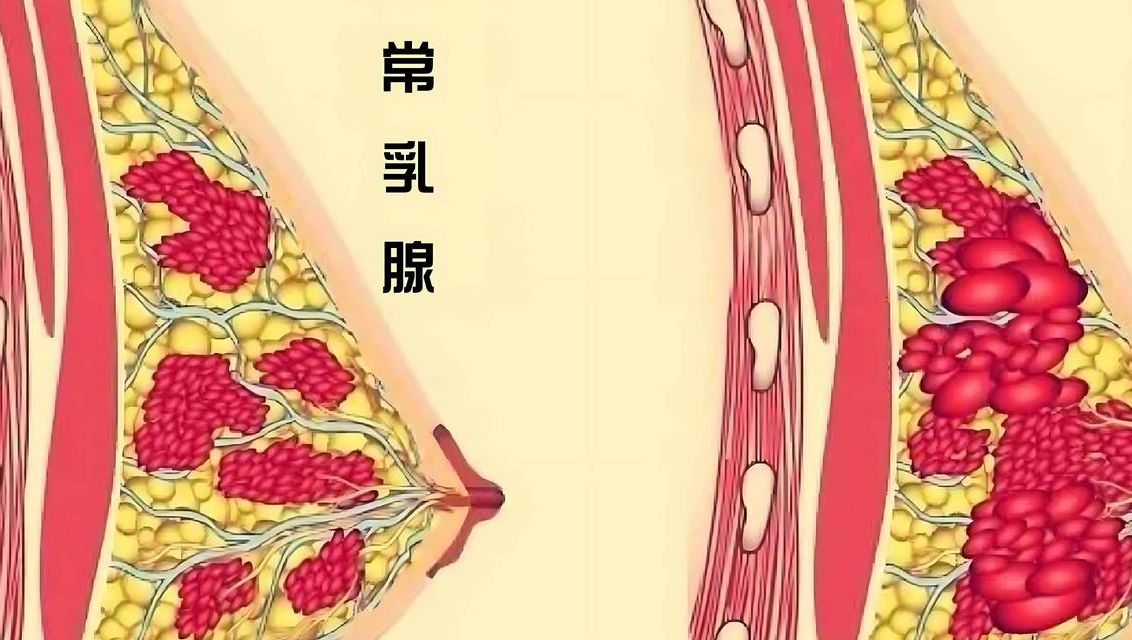 女性乳房有结节正常吗？先别慌，九成良性但别不管它