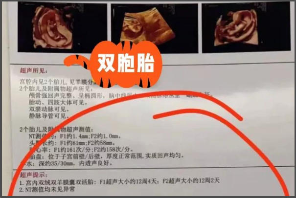 试管双胞胎不一定有双胎基因