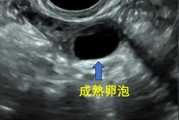 来例假查卵泡是为了评估卵巢储备