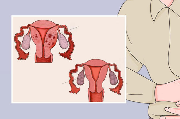 子宫畸形治疗时间因人而异