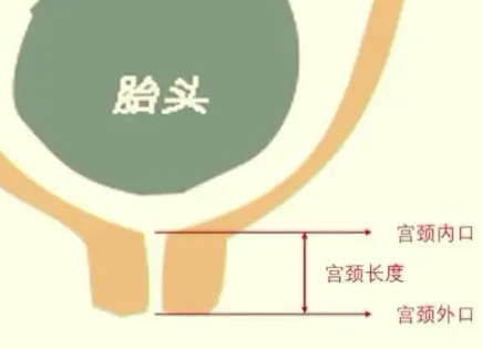 宫颈短有什么办法补救.png