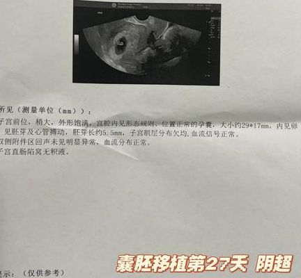 松康泉对试管移植有用吗？两次生化后，第三次移植我终于听见了胎心