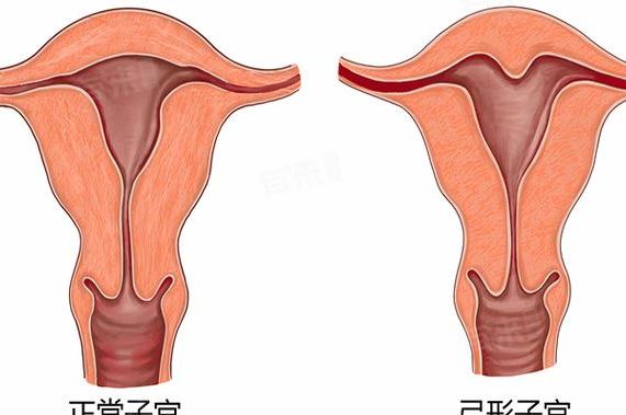 弓形子宫影响怀孕吗？2025最新研究给出关键答案
