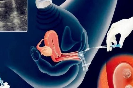 试管婴儿女方难受吗?卵母细胞采集疼不疼,移植后身体反应全说清
